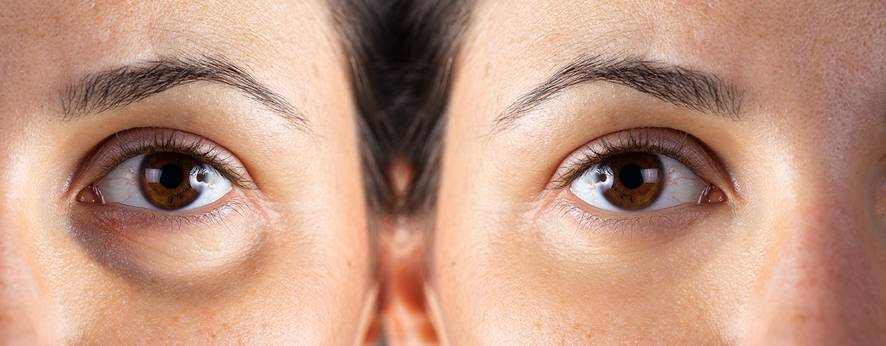 Gözaltı Işık Dolgusu